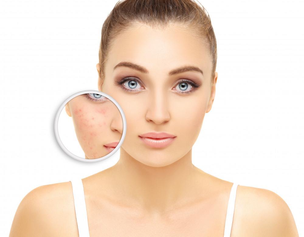 PRP Facial Treatment in Islamabad