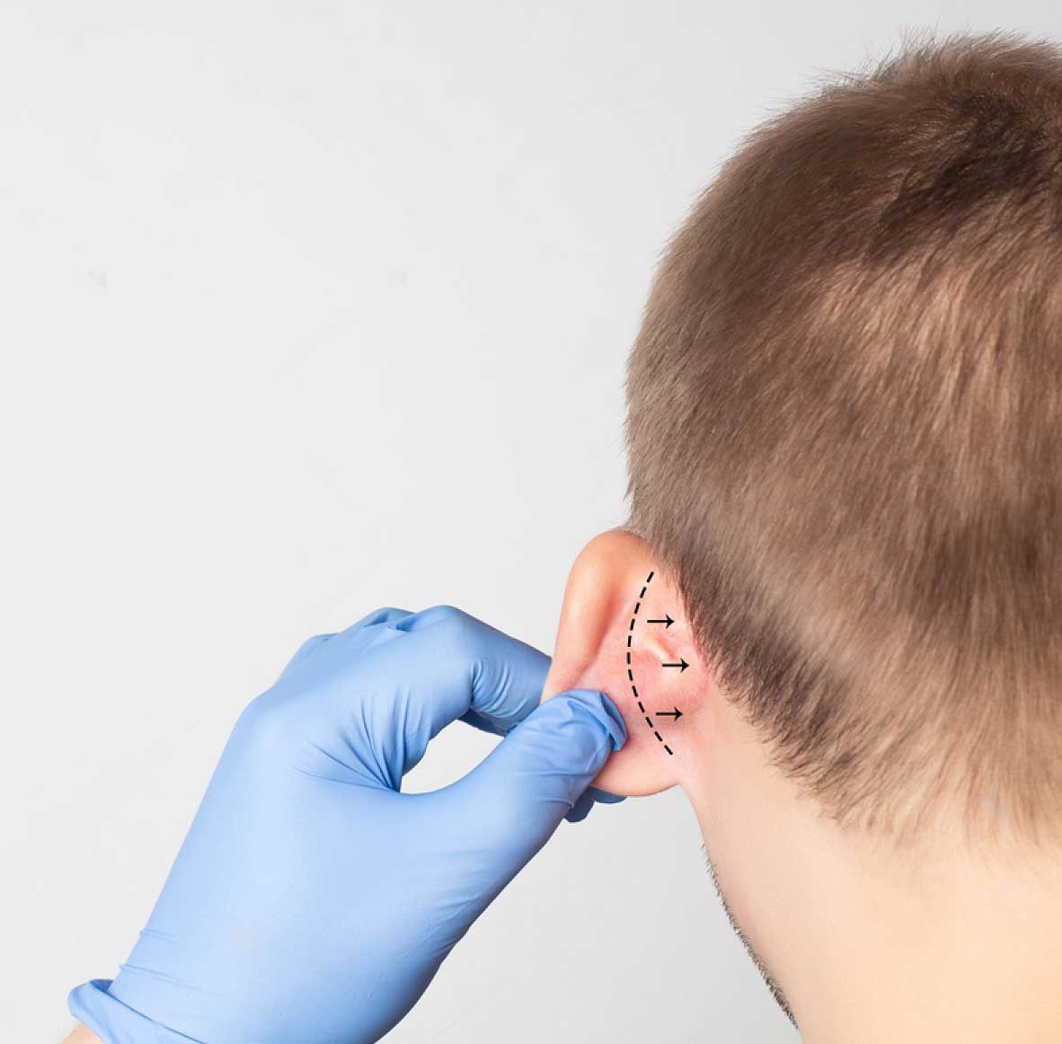 Otoplasty