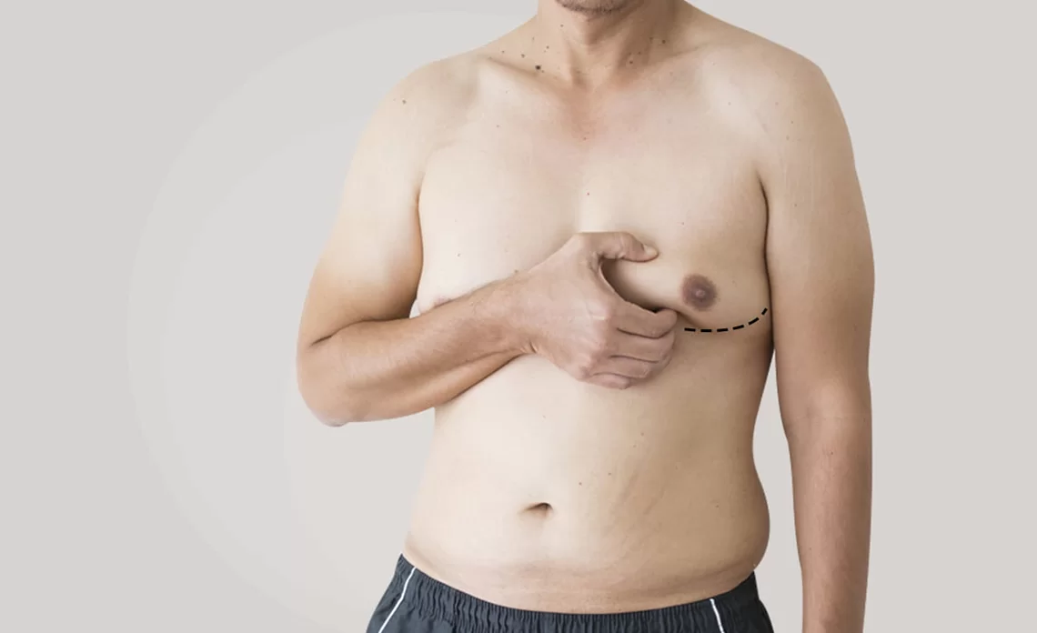 Gynecomastia in Islamabad