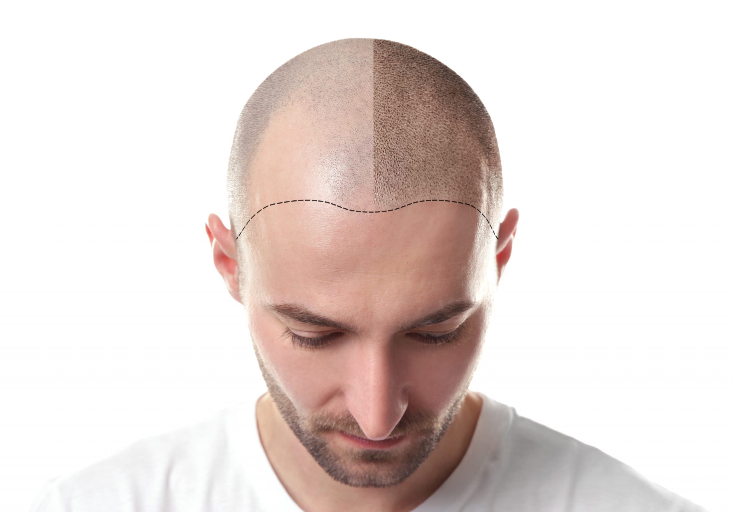 best hair transplant in islamabad