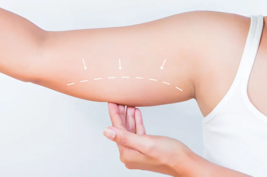 Arm Lift Surgery in Islamabad