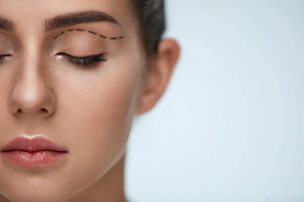 Eyelid Surgery In Islamabad