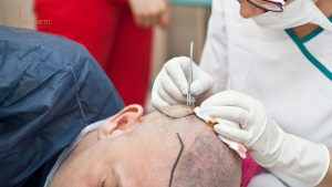 Understanding the Best Hair Transplant Techniques