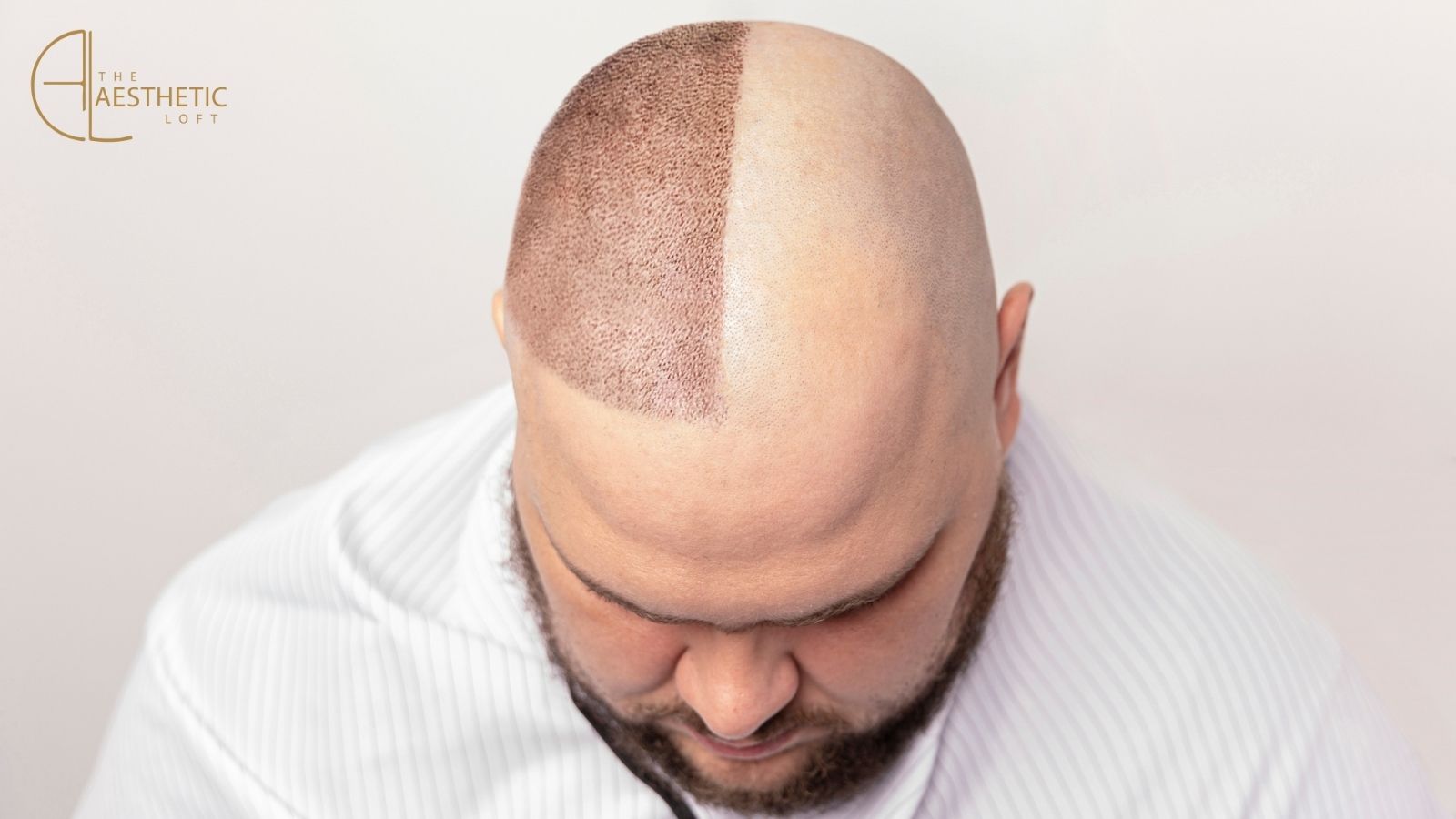 Comprehensive Guide to Hair Transplant