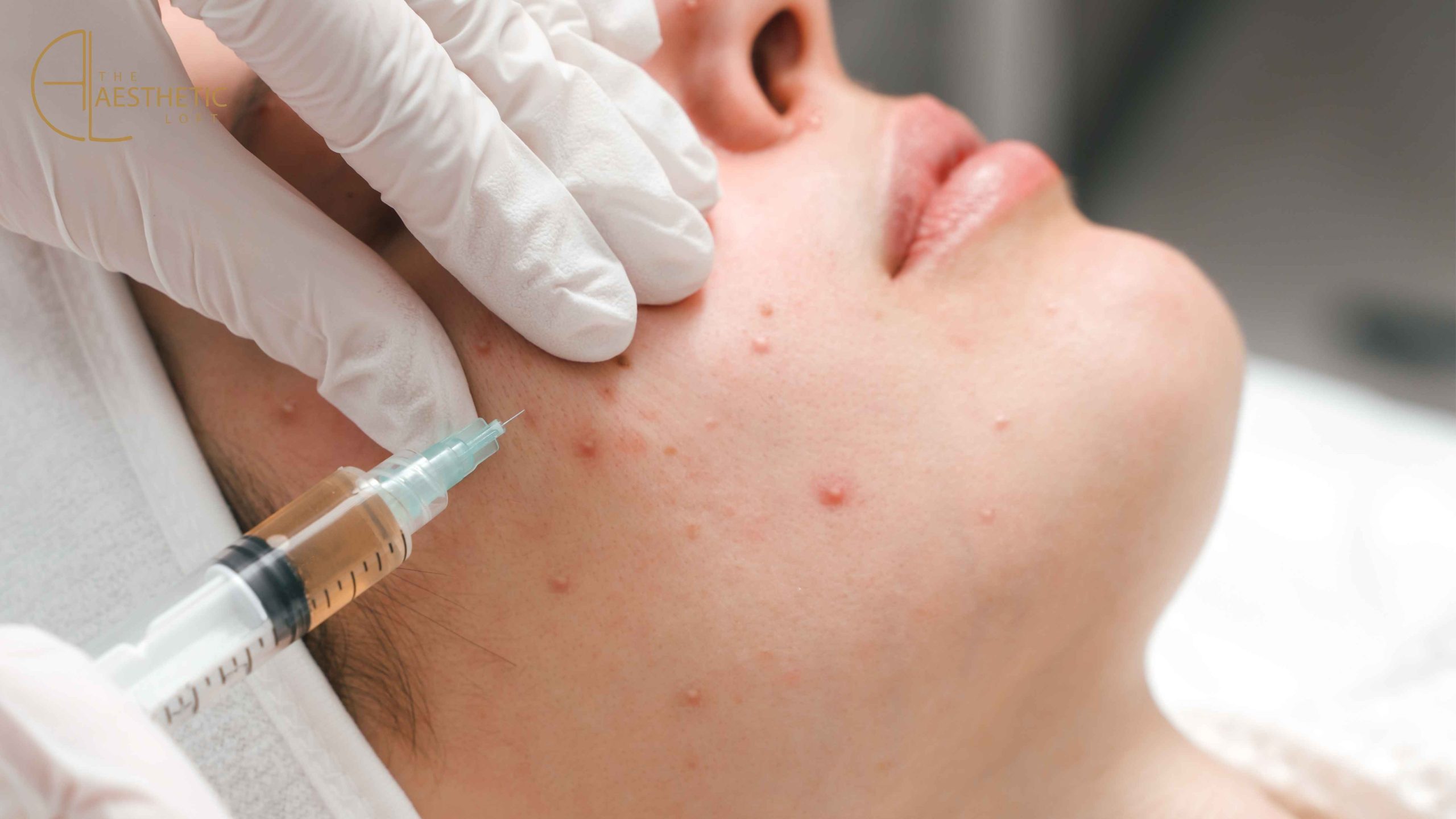 Is PRP Effective for Acne Scars