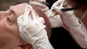 How to Sleep After FUE Hair Transplant
