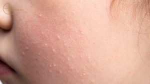 milia treatments in Islamabad