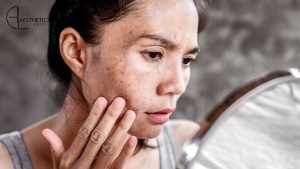 How To Remove Dead Skin After Microneedling