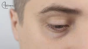 How to Remove Eye Bags Permanently