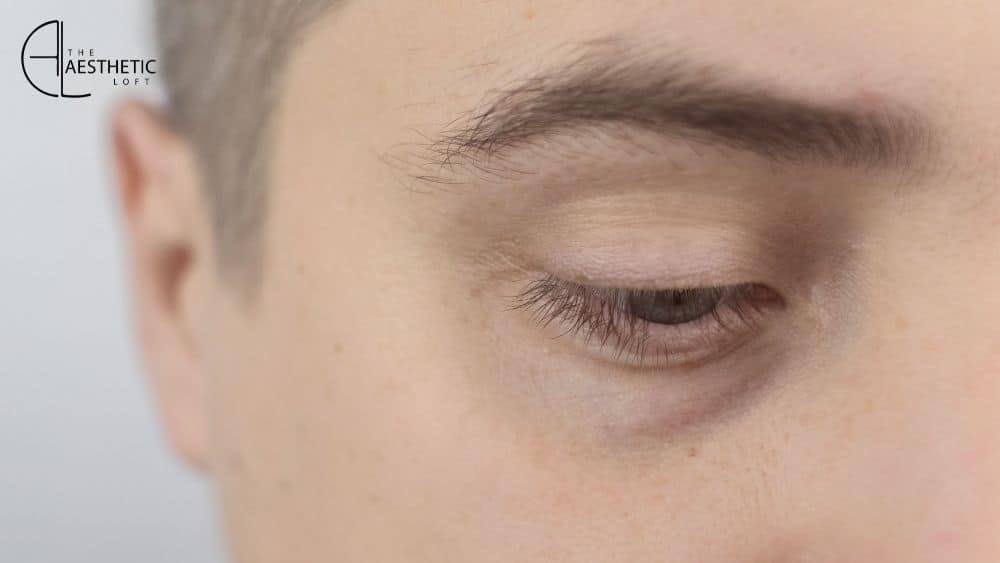 How to Remove Eye Bags Permanently