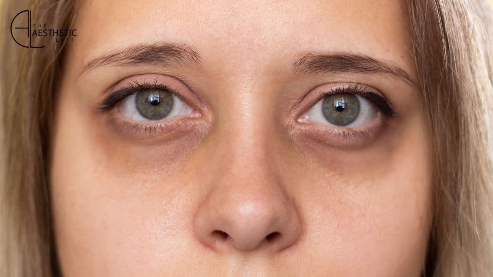 How Quickly Do Under-Eye Fillers Work