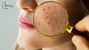 Acne Scars Treatment in Islamabad