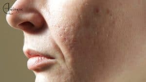 Best Treatments for Large Open Pores