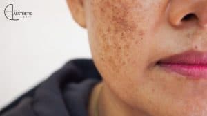 How to Treat Pigmentation & Dark Spots Safely in Summer