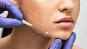 PDO Thread Lift: Everything You Need to Know Before Getting One
