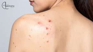 How to Get Rid of Stubborn Back Acne