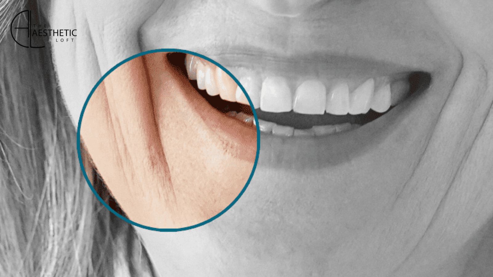 Marionette Lines Treatment: Can Fillers Really Turn Back Time