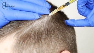 Exosomes After Hair Transplant