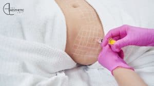 Kybella vs. Fat Dissolving Injections: Double Chin Treatment Comparison